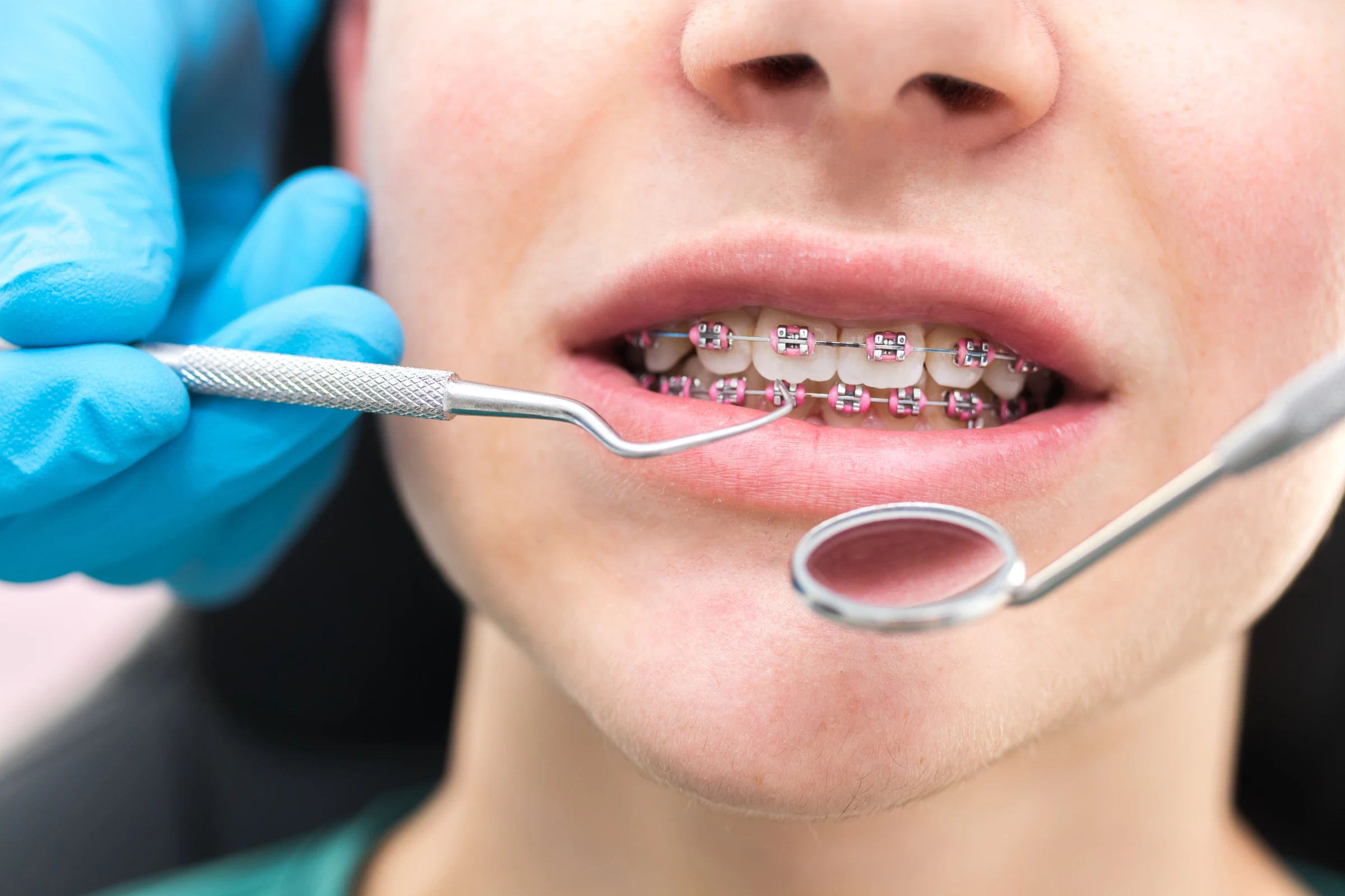 Kieferorthopädische Behandlung bei Dentheart Buchs